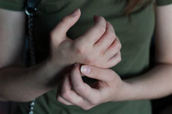 Sådan undgår du fnat: Gode råd til dig og din familie